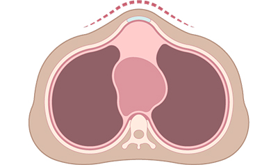 Pectus Carinatum