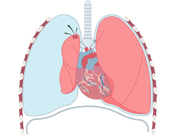 Spontaneous Pneumothorax