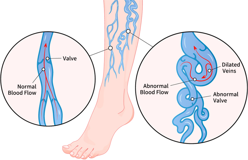 Chronic Venous Insufficiency