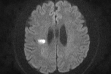 Acute Cerebral Infarction