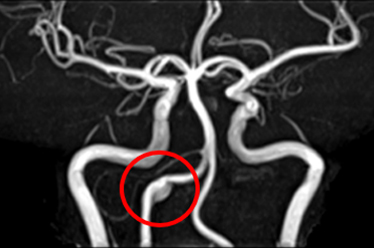 Vertebral Artery Dissection