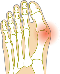 Hallux Valgus