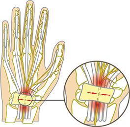 Carpal Tunnel Syndrome