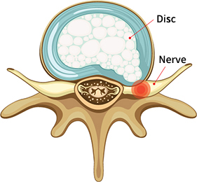 Transverse Plane of Disc