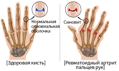 Ревматоидный артрит колена