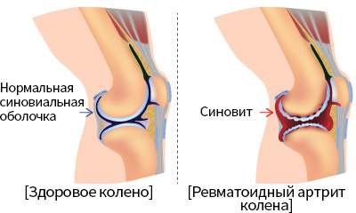 Ревматоидный артрит пальцев рук